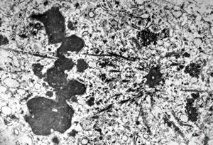 M, 62y. | mitosis … angiomatous tumor, v.s. Kaposi sarcoma M, 62y. | mitosis … angiomatous tumor, v.s. Kaposi sarcoma